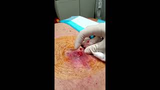 HD Graphic Step by Step Abscess and Infected Lipoma Drainage Medical Education amp Training [upl. by Hough757]