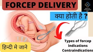 Forcep Delivery  What is forcep delivery  Hindi Medical knowledge 360°OBG medicineformula [upl. by Lupien]