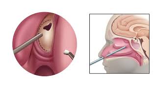 Endoscopic Endonasal Approach for Pituitary Tumor Removal [upl. by Gillette361]