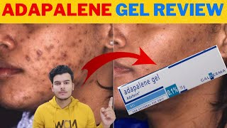 Adapalene Gel Adaferin 01 Review In Hindi  Best Gel For Removing Blackheads and Whiteheads [upl. by Suoivatnom688]