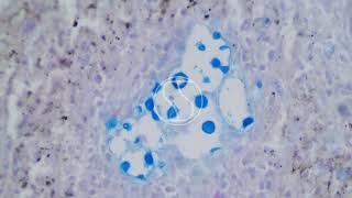 Cryptococcus neoformans under the microscope with Alcian Blue and PAS Stain [upl. by Hagi]