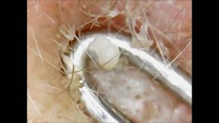 Popping Pimples and Blackheads under microscopic camera [upl. by Yuk]