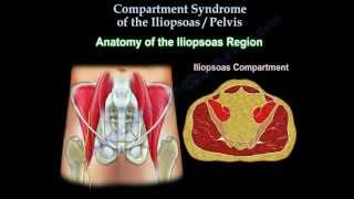 Iliopsoas Pelvic Compartment Syndrome Everything You Need To Know Dr Nabil Ebraheim [upl. by Riha]