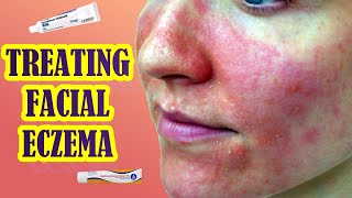 Treating Facial Eczema  Topical Steroids vs Tacrolimus [upl. by Marelya223]