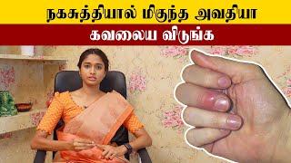 How to Cure Paronychia  நகசுத்தி குணப்படுத்துவது எப்படி  Samayam Tamil [upl. by Ngo]