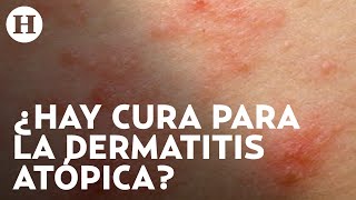 Dermatitis atópica Qué la causa cuáles son los síntomas y qué tratamientos hay  Médico H [upl. by Ardnikal]