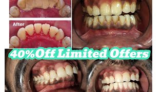 Scaling and Polishing Price in PakistanTooth whitening costBleaching procedureScalingProcedure [upl. by Adaner607]