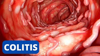 La COLITIS explicada síntomas tipos consecuencias tratamiento prevención [upl. by Faun]