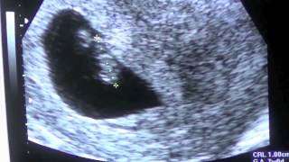 Pregnancy Vlog Week 7 First Ultrasound [upl. by Onitsuaf]