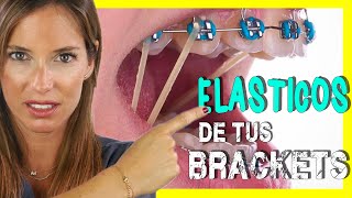 🖍📒ELASTICOS INTERMAXILARES para asentar MORDIDA  Para que sirven las GOMAS de los BRACKETS [upl. by Ahsenal]