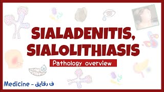 Sialadenitis amp Sialolithiasis  salivary gland diseases pathology overview head amp neck surgery شرح [upl. by Germayne]