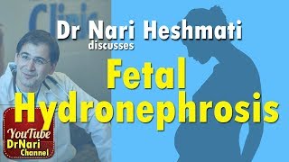 Fetal Hydronephrosis also known as pyelectasis or pelviectasis Discussed by Dr Nari Heshmati [upl. by Hiroshi]