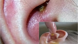 Five Easy Home Remedies How to Clean Your Ears Safely at Home [upl. by Werra]