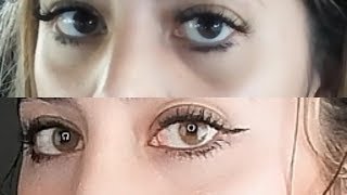 Dark Circles Under Eyes After Nose Job  HOW LONG [upl. by Alam]