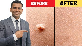 Remove Skin Tags and Warts Within 24 Hours  DrVivek Joshi [upl. by Neirrad114]