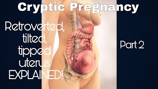 RetrovertedTiltedTipped Uterus EXPLAINED  Cryptic Pregnancy  Part 2 2021 [upl. by Ahsiret]