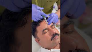 Forehead Filler  Micro Needling  face treatment  Face Glow [upl. by Ailekahs]