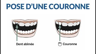 Comment le dentiste poseil une couronne [upl. by Ycak425]