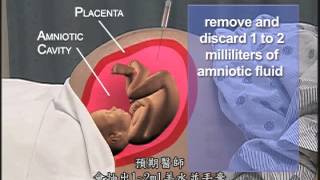 協助進行羊膜穿刺術Assisting During Amniocentesis [upl. by Tirrell]