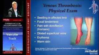 Diagnosis DVT and PE David Rigberg MD [upl. by Emlynn775]