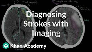 Diagnosing strokes with imaging CT MRI and Angiography  NCLEXRN  Khan Academy [upl. by Hsirahc]