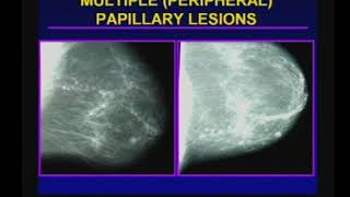 Management of Papillary Breast Lesions [upl. by Ainevul]