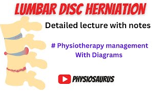 Lumbar disc herniation  Symptoms  Physiotherapy management  Advices  Diagnosis  Physiosaurus [upl. by Raye869]