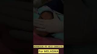 Melasma Treatment MicroNeedling  PRF amp Chemical Peel  Skincare  AlShifa Future Hospital [upl. by Nenerb]