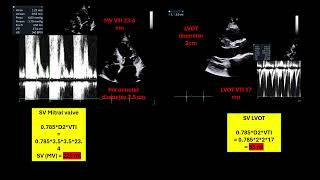 Echocardiographic features of Mitral valve flailProlapse with Severe Mitral Regurgitation [upl. by Apollo]