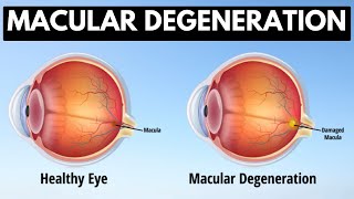 Macular degeneration Causes Signs and Symptoms Diagnosis and Treatment [upl. by Sokim342]