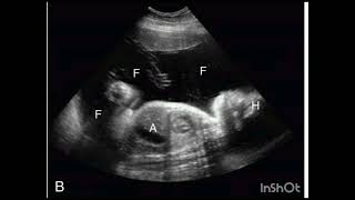 Subjective Assessment of Amniotic Fluid Normal Polyhydramnios OligohydramniosRequisites [upl. by Cirala]