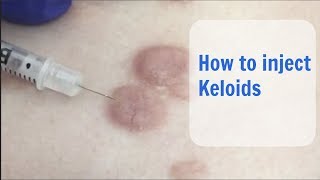 Keloid Injection  Cosmetic Institute of Australia [upl. by Carey]