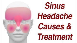 Sinus Headaches Causes amp Treatment [upl. by Kilmarx379]