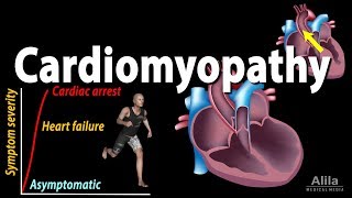 Cardiomyopathy animation [upl. by Oicirbaf635]