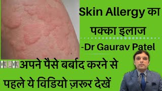 स्किन ऐलर्जी का इलाज।Skin Allergy Treatment At Home By Dermatologist Dr Gaurav Patel skinallergy [upl. by Miarhpe]