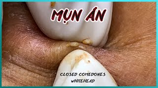 Big Cystic Acne Blackheads Extraction Blackheads amp Milia Whiteheads Removal Pimple Popping [upl. by Wrigley]