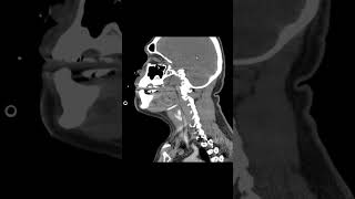 Epiglottitis CT [upl. by Ilera281]