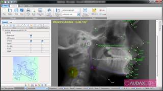 AudaxCeph  Analysis [upl. by Remark]