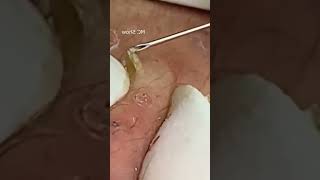 Pickel Ausdrücken Blackheads Mitesser Entfernung 🔴 61 [upl. by Sudnor930]