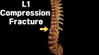 L1 First lumbar body Compression fracture [upl. by Berner]