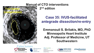 Case 35 Manual of CTO Interventions  IVUS facilitated ADR [upl. by Aivekal]