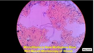 Microfilaria in blood Microscopy [upl. by Filomena304]