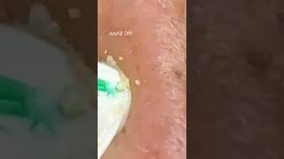 Pickel Ausdrücken Blackheads Akne amp Mitesser entfernen 🔴 24 [upl. by Nairret598]