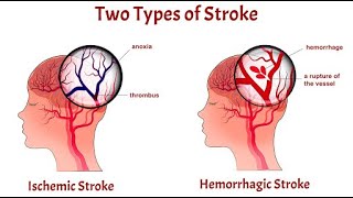 Stroke  Definisi Klasifikasi Etiologi Faktor Resiko Penyebab Gejala Diagnosis Pengobatan [upl. by Ithsav]