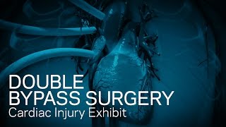 Double Bypass Surgery  Cardiac Injury Exhibit [upl. by Orlov810]