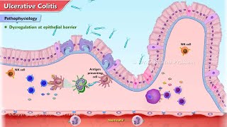 Ulcerative Colitis Animation  Etiology Clinical features Pathophysiology Diagnosis Treatment [upl. by Romaine521]