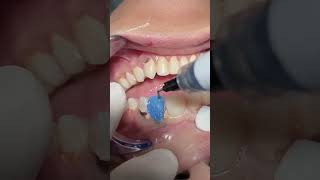 Deep caries with Composite veneer dentist [upl. by Neliac]