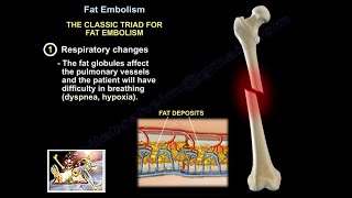 Fat Embolism  Everything You Need To Know  Dr Nabil Ebraheim [upl. by Ibot]