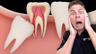 Is Removing Your Wisdom Teeth BAD For You [upl. by Mccurdy]