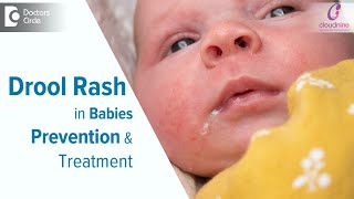 DROOL RASH IN BABIES  Causes amp TreatmentDrSpoorti Kapate of Cloudnine Hospitals  Doctors Circle [upl. by Fortna]